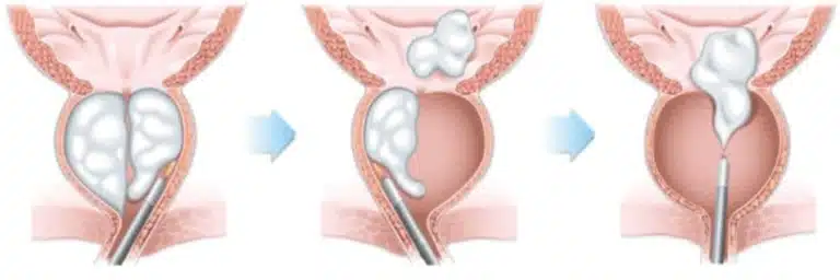 Holmium and Thulium Fibre Laser Enucleation of the Prostate