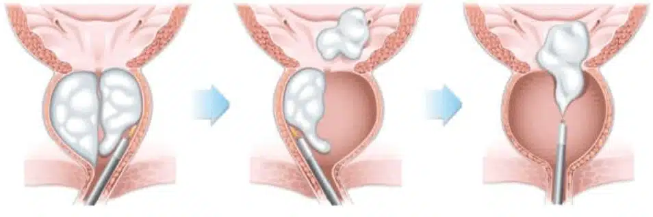 Holmium and Thulium Fibre Laser Enucleation of the Prostate